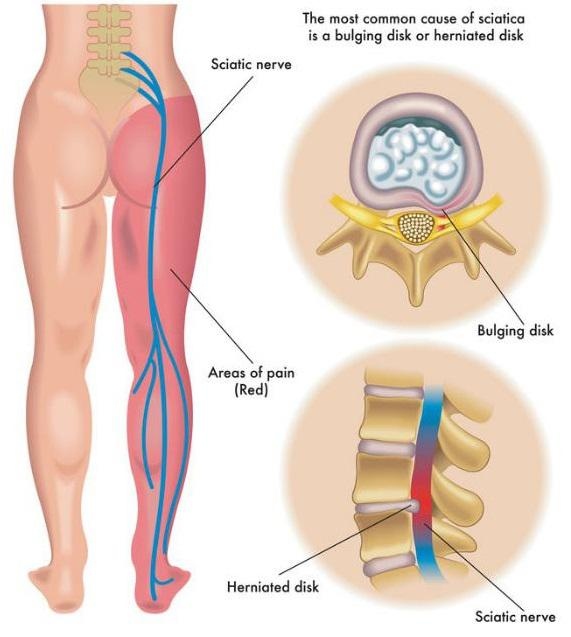 Union Chiropractor | Union chiropractic Sciatica & Leg Pain |  NJ |
